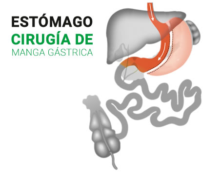 Estómago con cirugía de manga gástrica